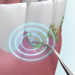 Sale Tempsl Détartreur ultrasons